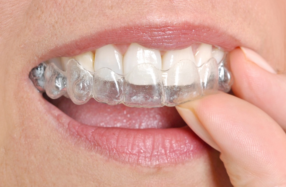 ventajas de la ortodoncia invisible
